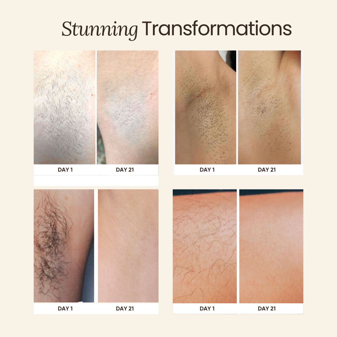 Soothe Permanent Hair Removal Handset